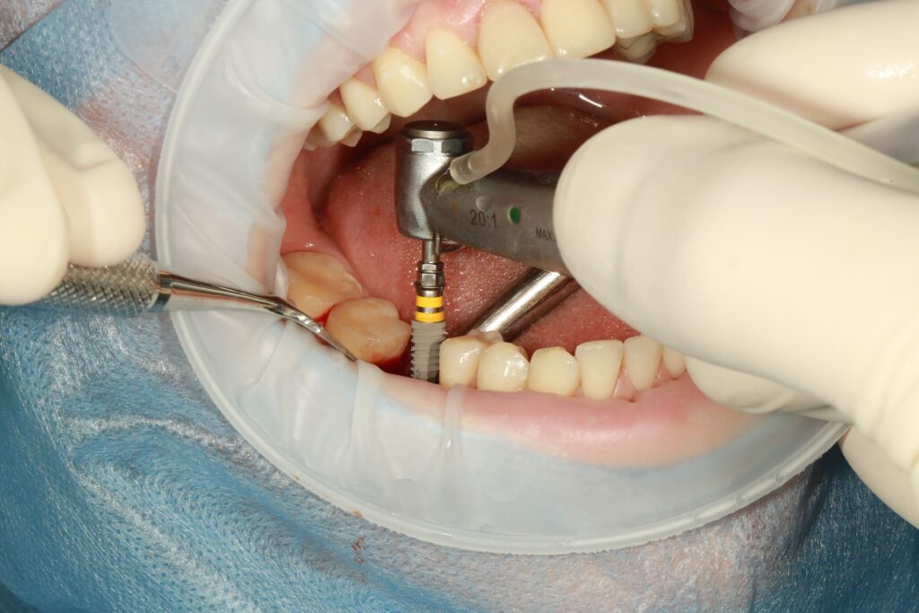 implant-dentistry-jammu.jpg Dental implant services in Jammu by Dental Botanica