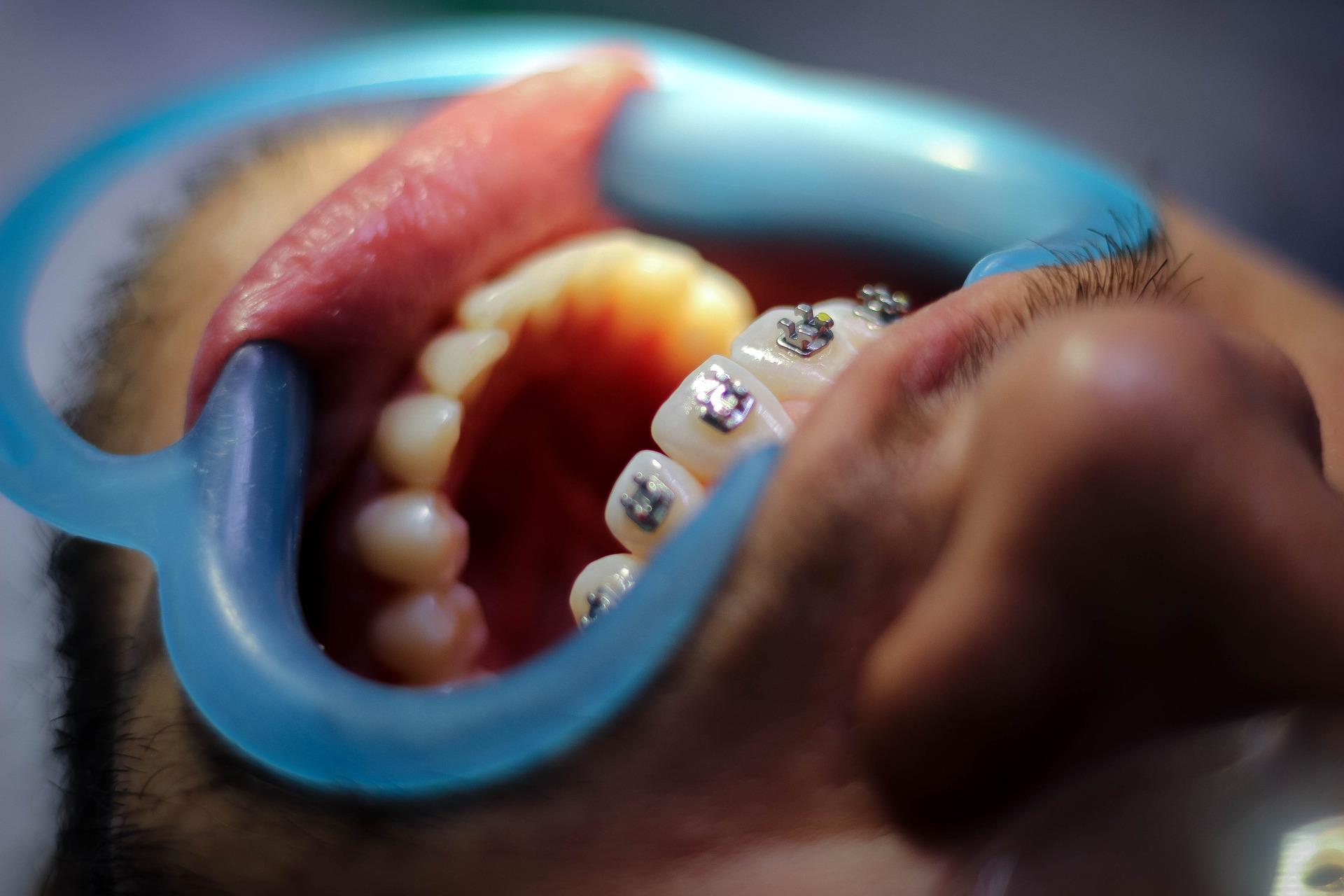 Teeth alignment options in Jammu at Dental Botanica